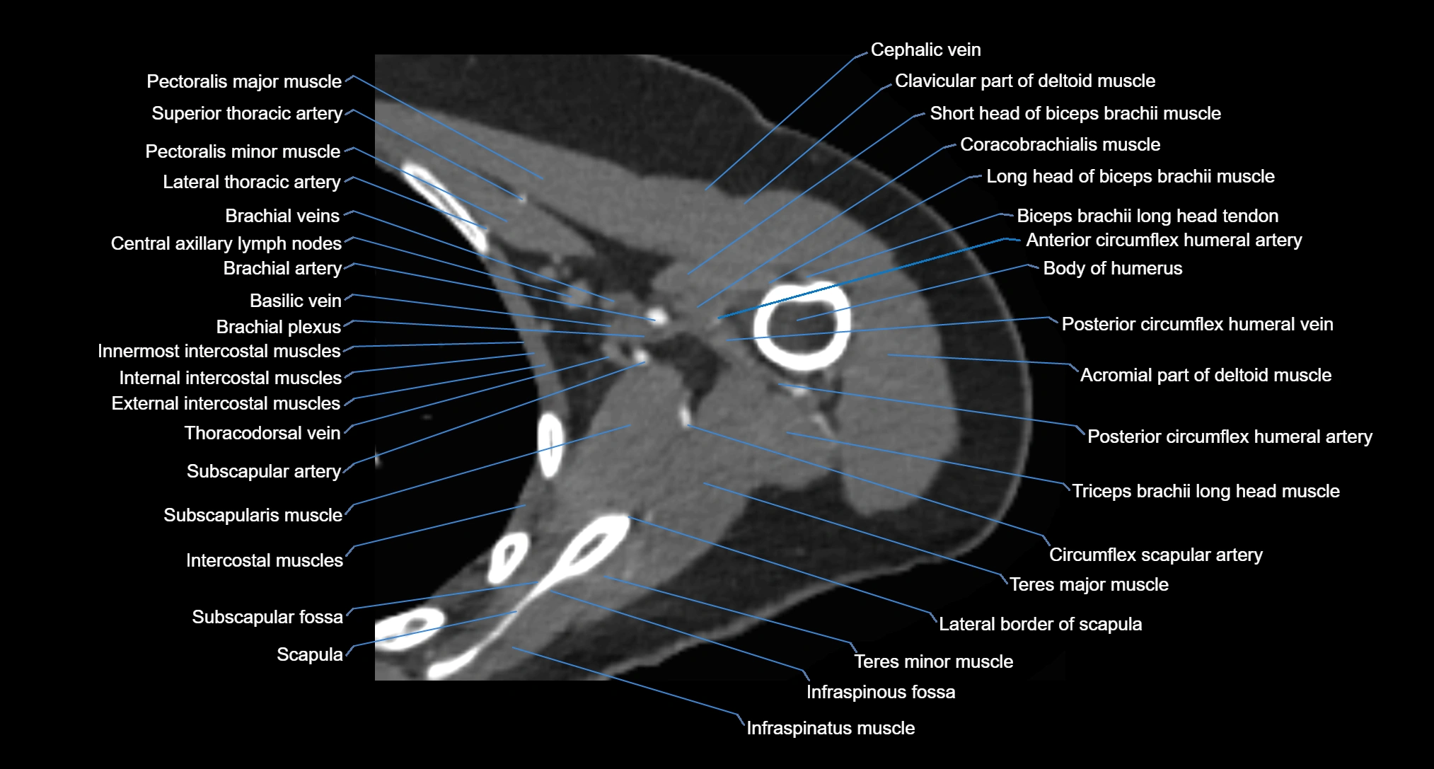 CT Shoulder axial cross sectional anatomy labelled radiology image -00050.webp